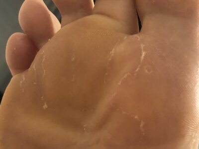 Dead skin picking on my feet